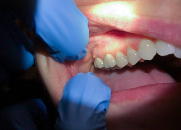 Best Tooth Infection Emergency Dentist  in Isla Vista, CA