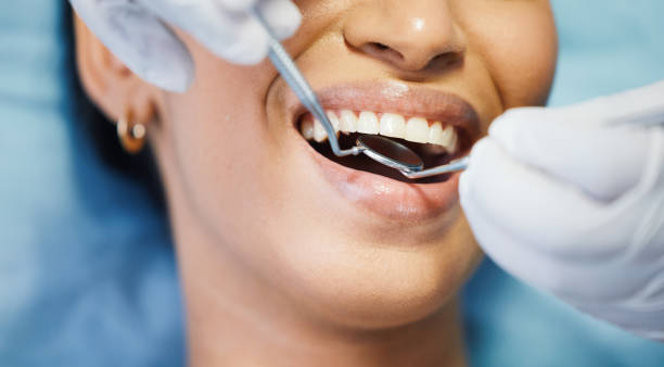 Best Chipped Tooth Repair Near Me  in Isla Vista, CA